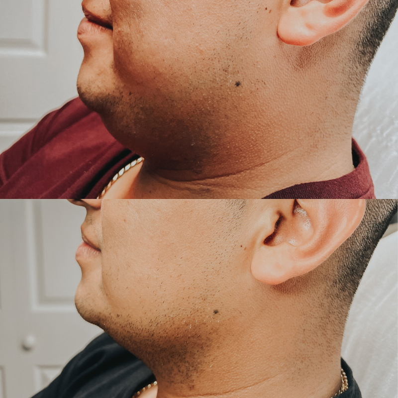 two combinations of one face before and after treatment MEDICAL SPA IN ORLANDO, FL