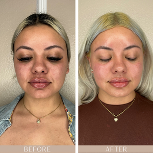 Skin Treatment Before and After